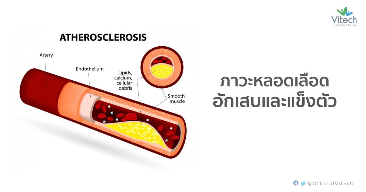 การป้องกันภาวะหลอดเลือดอักเสบและแข็งตัว